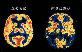 阿兹海默症与大脑中的铁沉积有关？