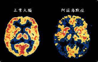 阿兹海默症与大脑中的铁沉积有关？