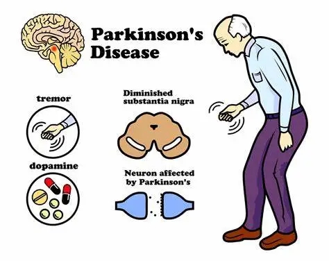 帕金森病的11种可能原因，看你有没有中招？