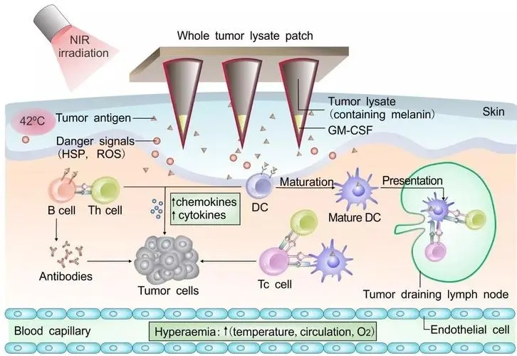 特殊生物标志物或能帮助预测黑色素瘤患者对免疫疗法的反应