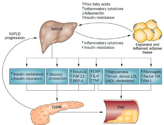 NAFLD与T2DM的因果关系